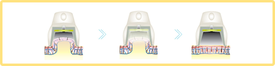 図：独自の吸引システムで痛みを軽減した脱毛が可能